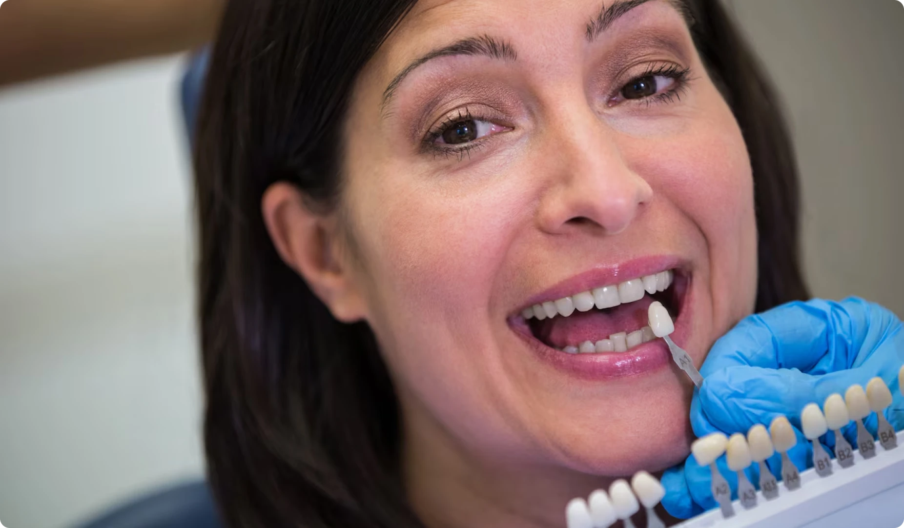 Blanqueamiento dental